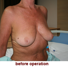plastic-surgery-breast-lift